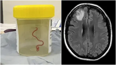 Una mujer sufrió extraños síntomas por años hasta que descubrieron que tenía un gusano vivo en el cerebro