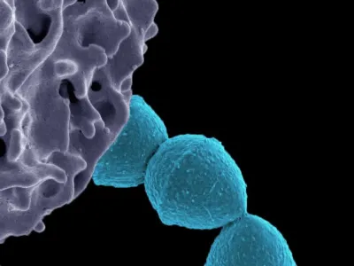 Alerta por una súper bacteria: el brote por Streptococcus pyogenes ya causó 64 muertes en el país