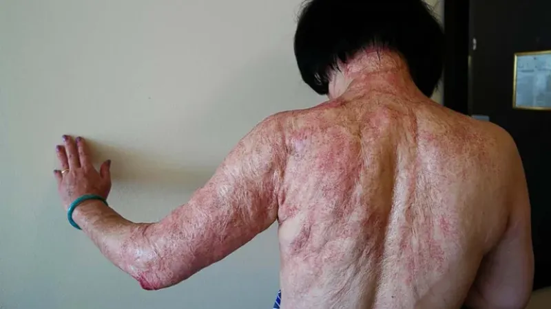 En esta foto del 27 de septiembre de 2015, Kim Phuc muestra las cicatrices de quemaduras en la espalda y los brazos causados ??por una bomba de napalm en Vietnam