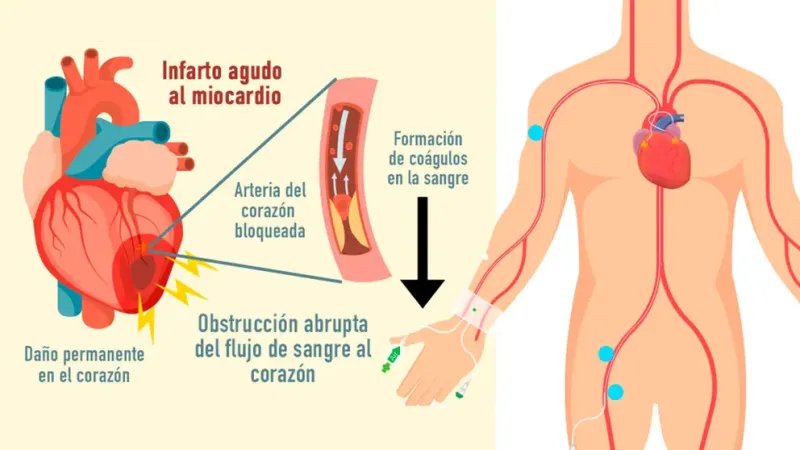  Cómo se produce un ataque cardíaco (UNAM)