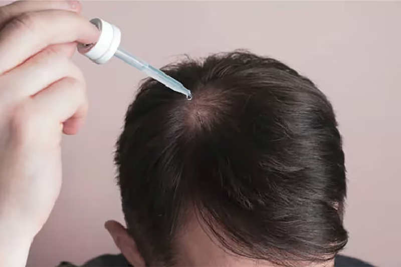  A diferencia de los hombres que tienen entradas del cabello o una calva, en las mujeres a menudo es más difuso, donde el cabello en toda la parte superior de la cabeza es un poco más delgado (Gentileza: Rocco)